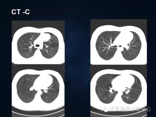【病例】胸腺囊肿1例CT影像表现与鉴别