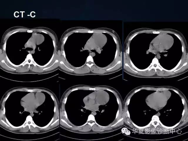 【病例】胸腺囊肿1例CT影像表现与鉴别