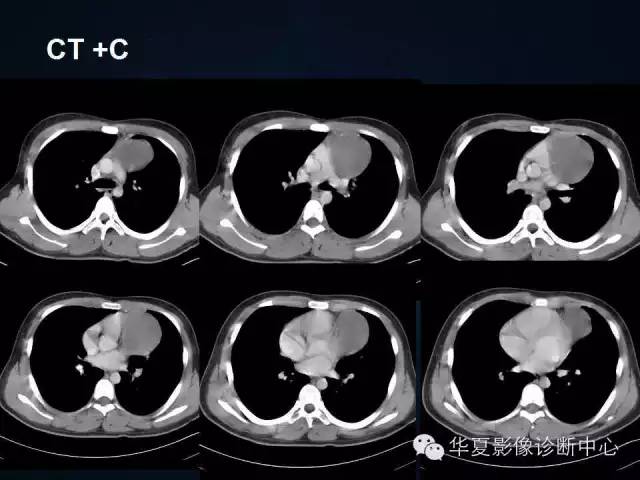 【病例】胸腺囊肿1例CT影像表现与鉴别