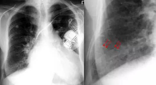 盘状肺不张 Plate Atelectasis
