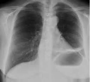 盘状肺不张 Plate Atelectasis 盘状肺不张 Plate Atelectasis