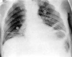 盘状肺不张 Plate Atelectasis 盘状肺不张 Plate Atelectasis
