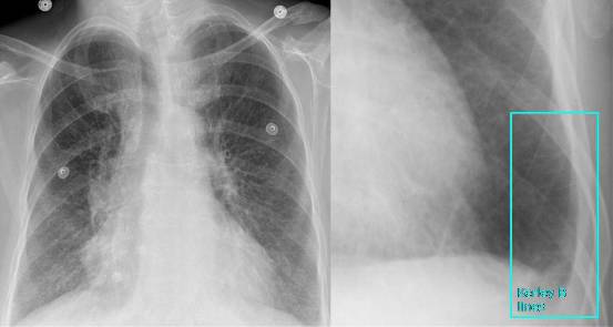 盘状肺不张 Plate Atelectasis 盘状肺不张 Plate Atelectasis