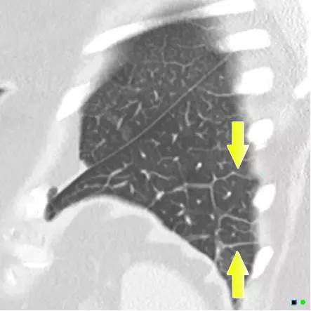 盘状肺不张 Plate Atelectasis 盘状肺不张 Plate Atelectasis