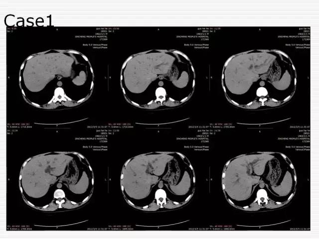 【PPT】胰腺囊性病变的鉴别诊断