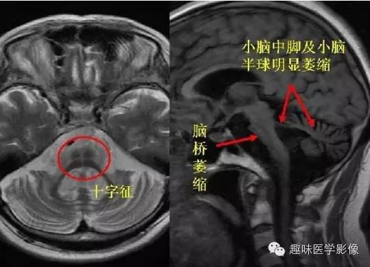 十大典型的神经影像学征象 十大典型的神经影像学征象