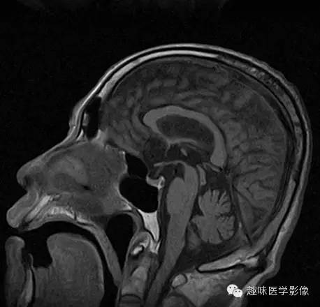 十大典型的神经影像学征象 十大典型的神经影像学征象