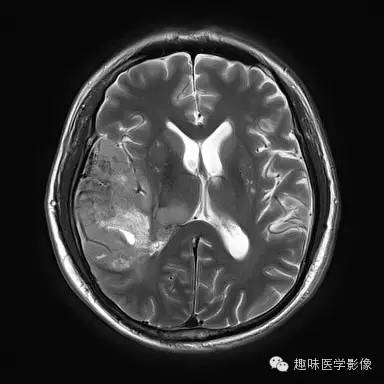 【病例】少突胶质细胞瘤1例MR影像表现 【病例】少突胶质细胞瘤1例MR影像表现