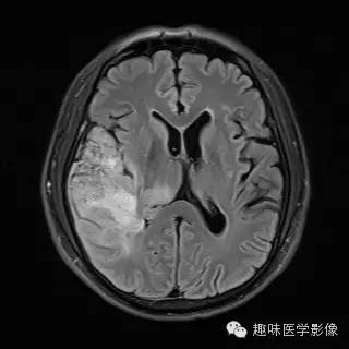 【病例】少突胶质细胞瘤1例MR影像表现 【病例】少突胶质细胞瘤1例MR影像表现