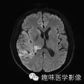【病例】少突胶质细胞瘤1例MR影像表现 【病例】少突胶质细胞瘤1例MR影像表现