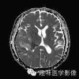 【病例】少突胶质细胞瘤1例MR影像表现 【病例】少突胶质细胞瘤1例MR影像表现