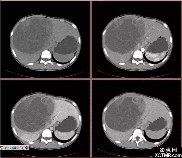 【病例】肝脏未分化肉瘤1例CT影像诊断分析 【病例】肝脏未分化肉瘤1例CT影像诊断分析