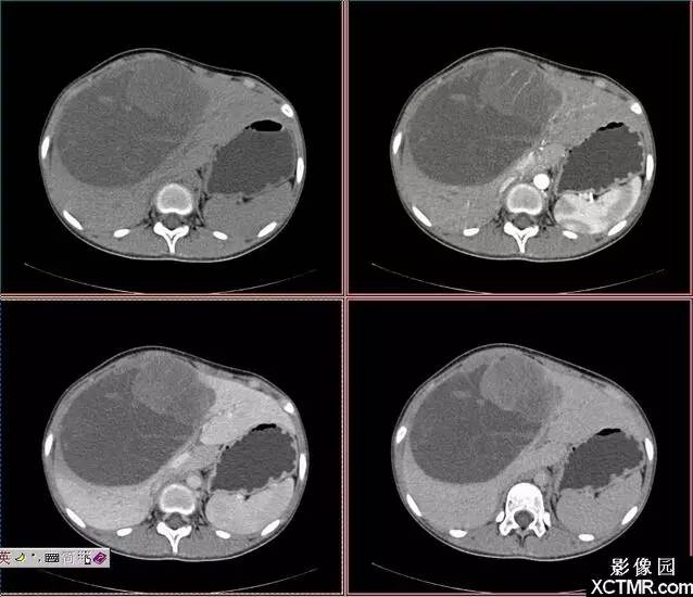 【病例】肝脏未分化肉瘤1例CT影像诊断分析 【病例】肝脏未分化肉瘤1例CT影像诊断分析