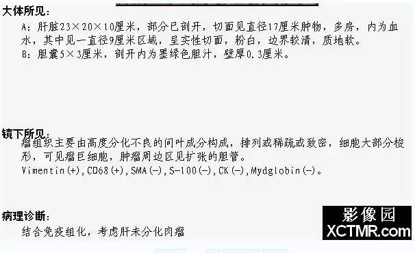 【病例】肝脏未分化肉瘤1例CT影像诊断分析 【病例】肝脏未分化肉瘤1例CT影像诊断分析