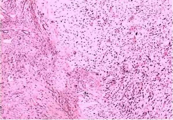 【病例】肝脏未分化肉瘤1例CT影像诊断分析 【病例】肝脏未分化肉瘤1例CT影像诊断分析