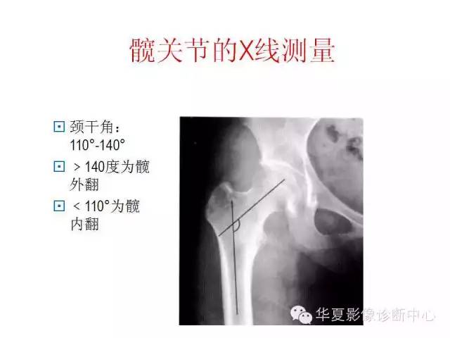髋关节X线测量方法