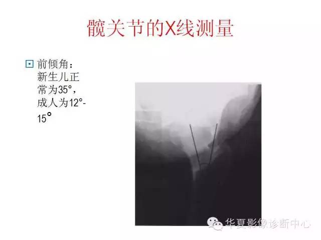 髋关节X线测量方法