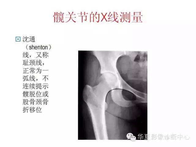 髋关节X线测量方法