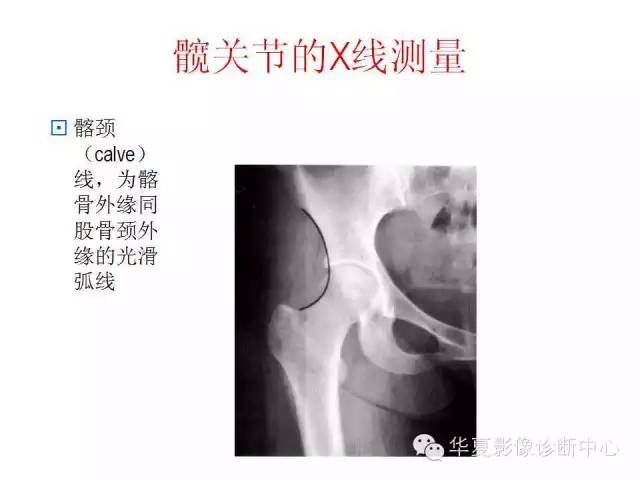 髋关节X线测量方法