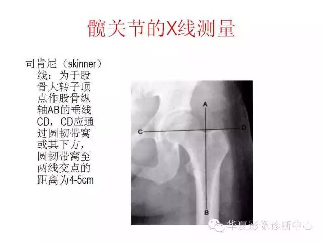 髋关节X线测量方法