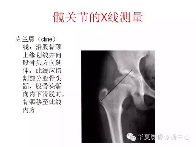 髋关节X线测量方法