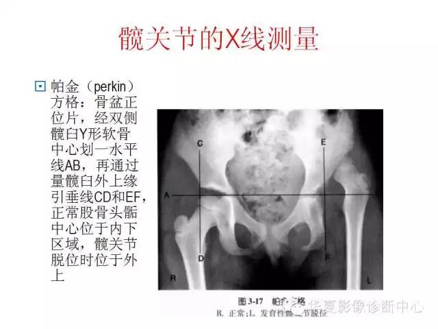 髋关节X线测量方法