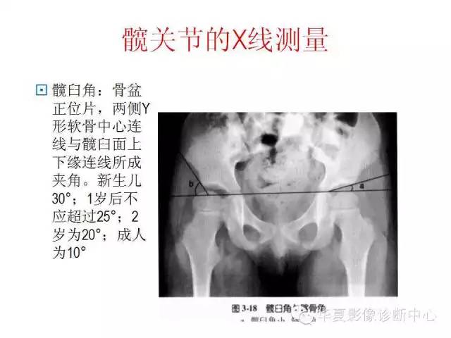 髋关节X线测量方法