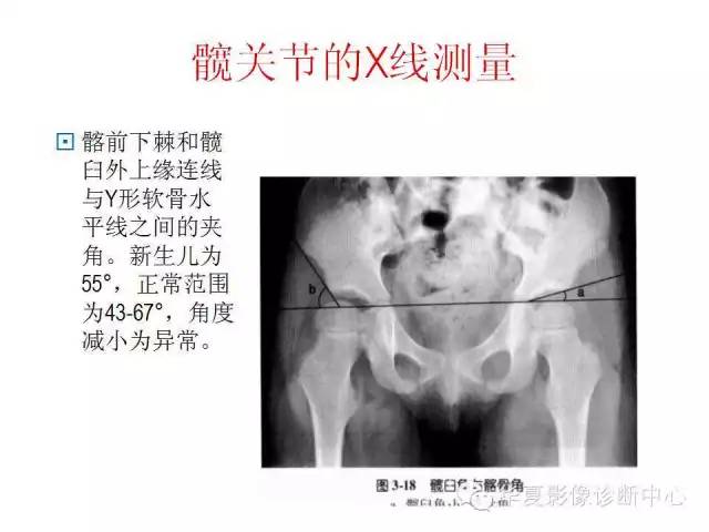 髋关节X线测量方法
