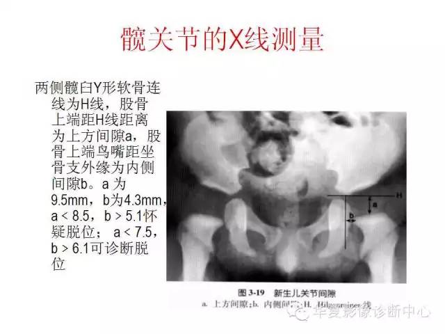 髋关节X线测量方法