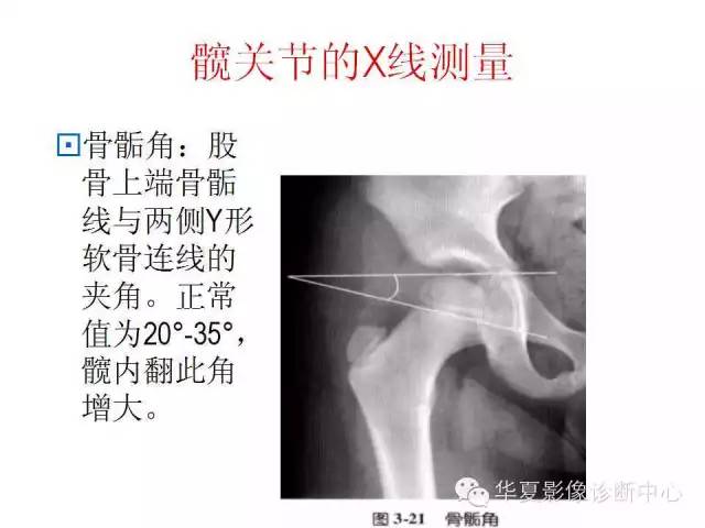 髋关节X线测量方法