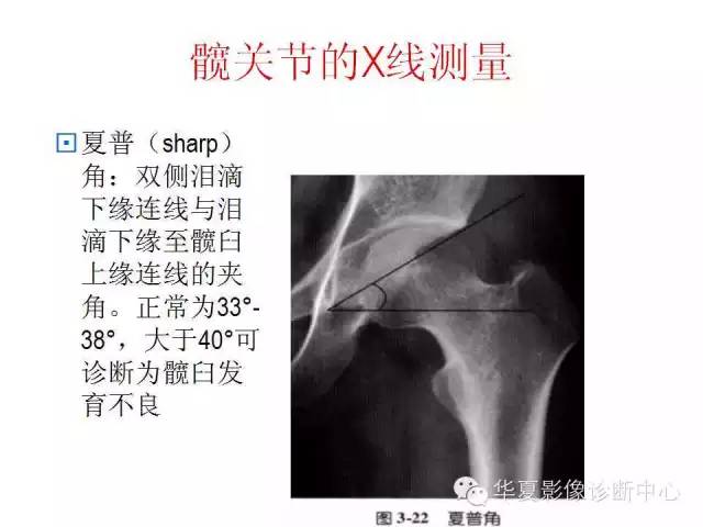 髋关节X线测量方法