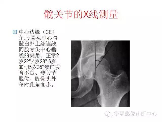 髋关节X线测量方法