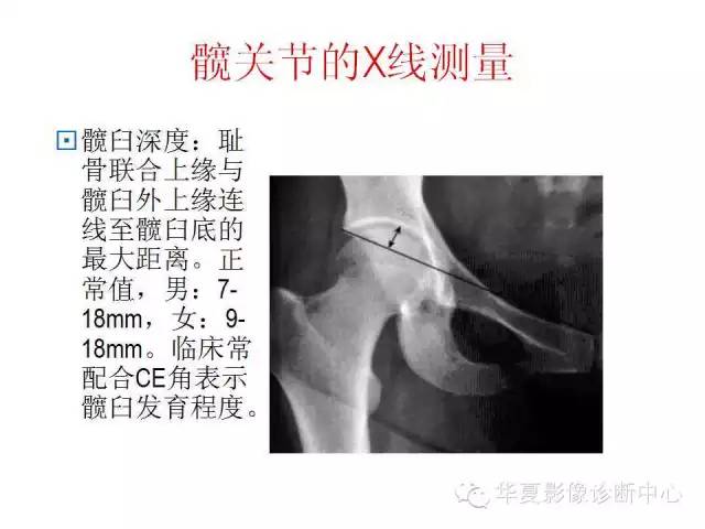 髋关节X线测量方法