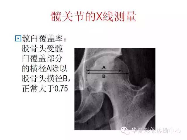 髋关节X线测量方法