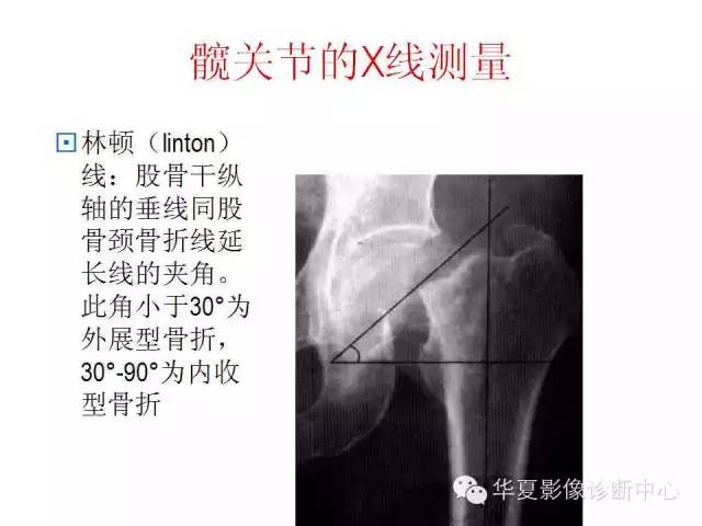 髋关节X线测量方法