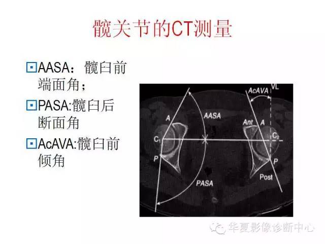 髋关节X线测量方法