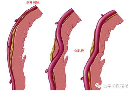 冠状动脉解剖及变异