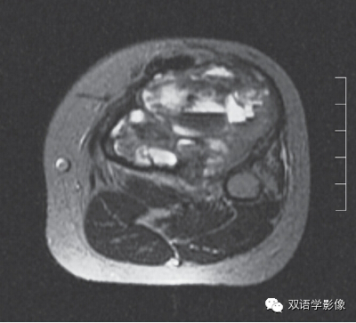 Lesions with Fluid-Fluid Levels 含液-液平面的病变