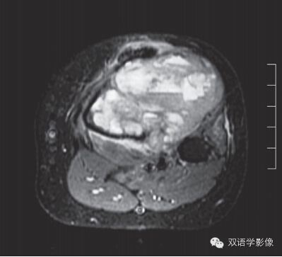Lesions with Fluid-Fluid Levels 含液-液平面的病变 Lesions with Fluid-Fluid Levels 含液-液平面的病变
