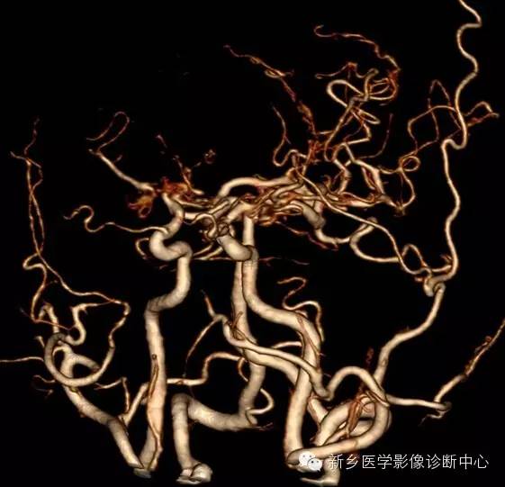 烟雾病的分型和分期 烟雾病的分型和分期