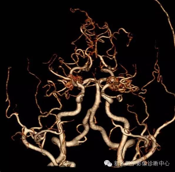 烟雾病的分型和分期 烟雾病的分型和分期