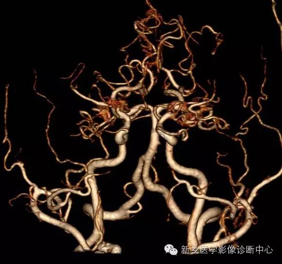 烟雾病的分型和分期 烟雾病的分型和分期