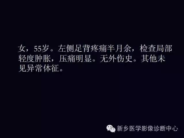 【病例】跖骨应力性骨折1例影像表现