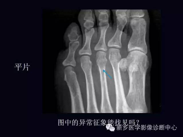 【病例】跖骨应力性骨折1例影像表现