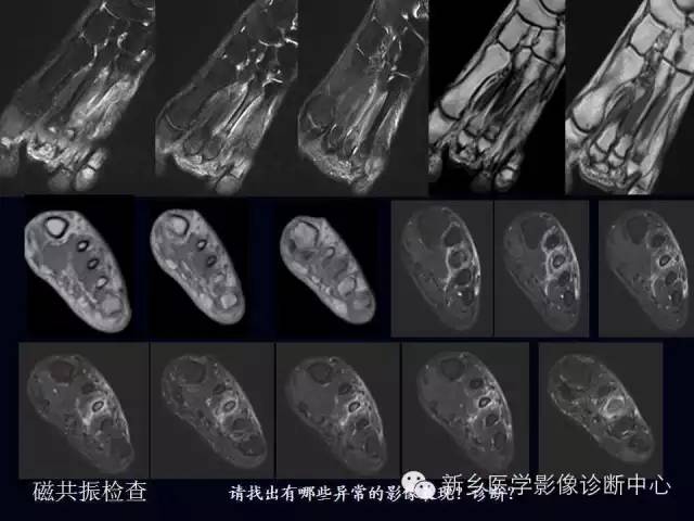 【病例】跖骨应力性骨折1例影像表现