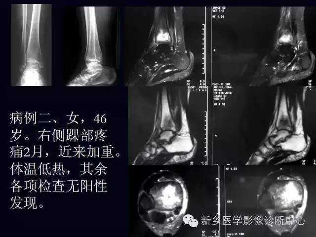 【病例】跖骨应力性骨折1例影像表现