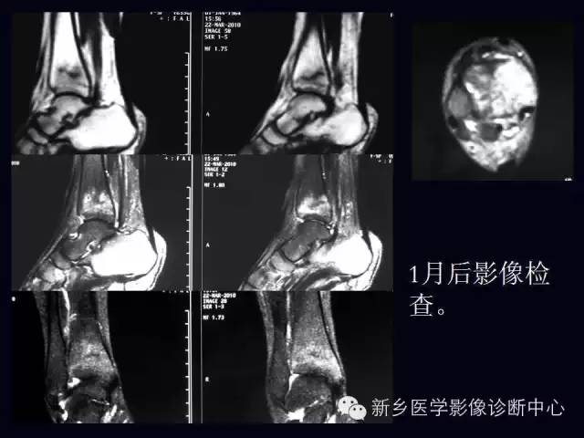 【病例】跖骨应力性骨折1例影像表现
