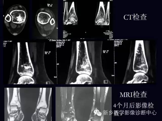 【病例】跖骨应力性骨折1例影像表现