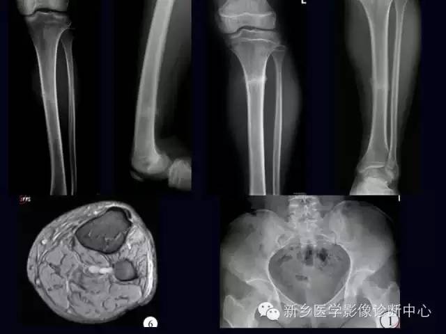 【病例】跖骨应力性骨折1例影像表现