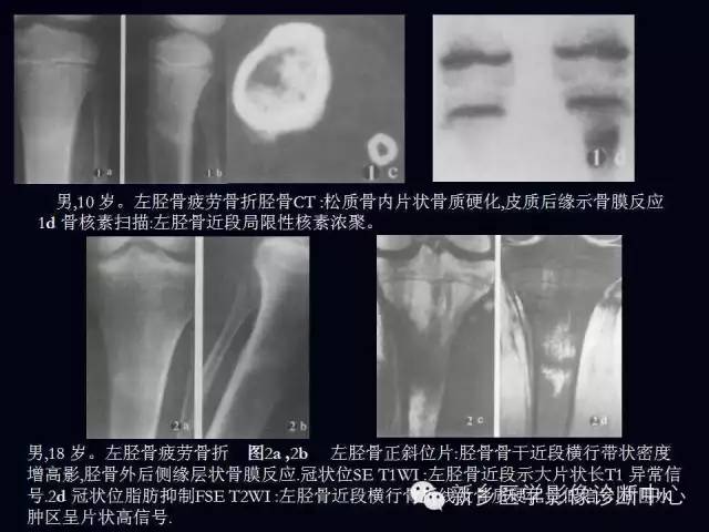 【病例】跖骨应力性骨折1例影像表现